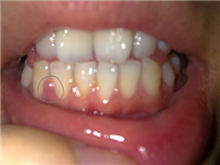 牙龈癌早期症状有哪些